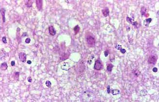Enfermedad de Aujeszky: Cuerpos de inclusin basfilos intranucleares
