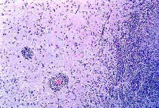 ESTREPTOCOCIA: Meningoencefalitis purulenta.