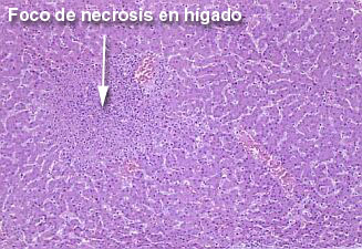 necrosis